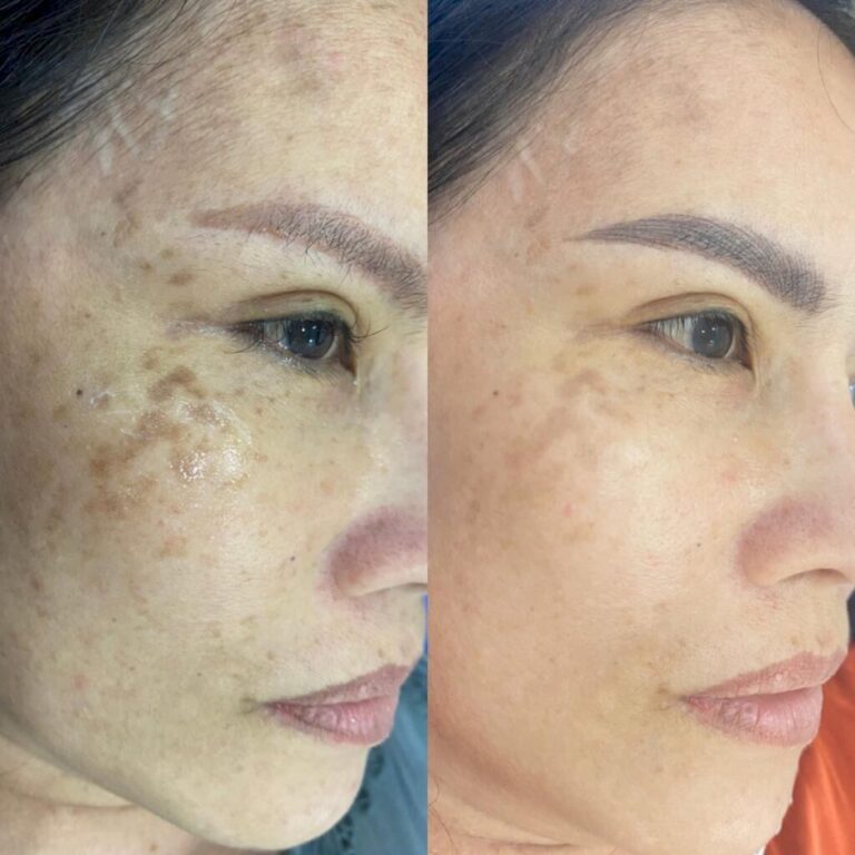 1.5 tháng sử dụng Nước uống đẹp da AGE20S Collagen Peptide