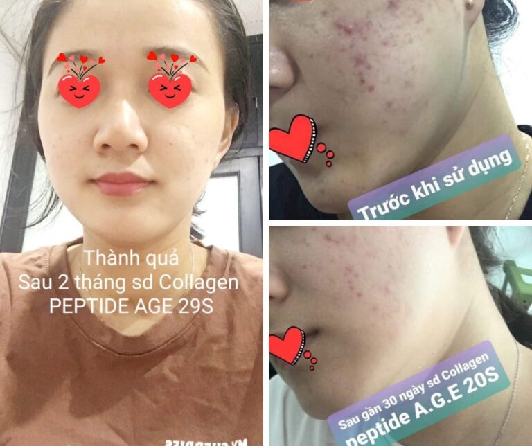 2 tháng sử dụng nước uống đẹp da AGE 20S Collage Peptide điều trị mụn