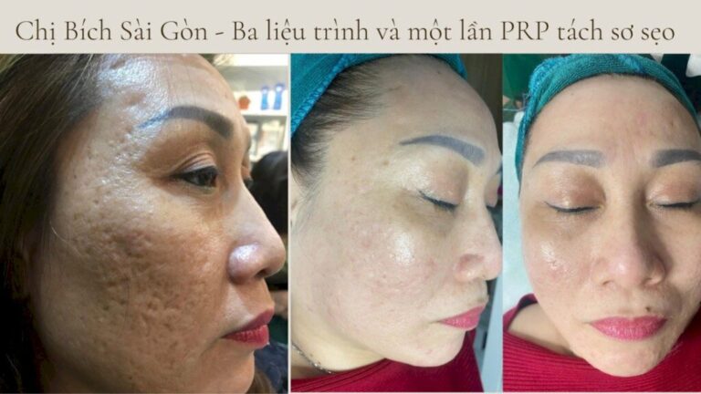 Lựa chọn Nước uống đẹp da AGE20s Collagen Peptide sau khi PRP tách sơ sẹo để phục hồi